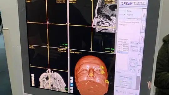 BAÜN Hastanesi'nde riskli beyin ameliyatı başarıyla yapıldı